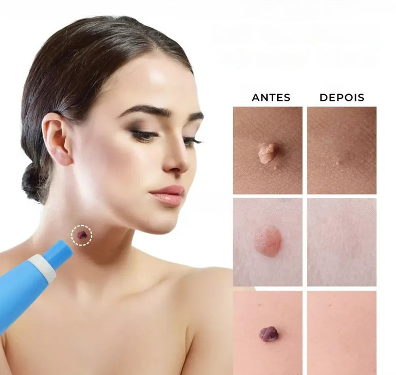 Caneta Removedora de Verrugas RemoVex™ (acrocordons)