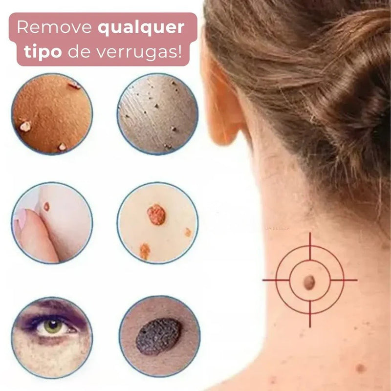 Caneta Removedora de Verrugas RemoVex™ (acrocordons)
